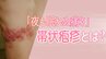 20代～40代で「帯状疱疹」が“急増”の理由　顔面神経麻痺、視力障害のリスクも…　重要なのは「初期症状」|TBS NEWS DIG