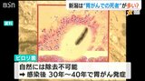 “胃がんによる死亡率”が全国ワースト7位の新潟県 塩分摂取量が多いとリスク高?さらにピロリ菌にも要注意|TBS NEWS DIG