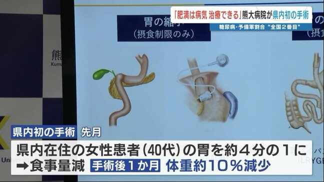 「胃を4分の1に切除」で体重10%減少 糖尿病・予備軍割合 “全国2番目”の熊本で初実施の肥満治療 手術の条件は|TBS NEWS DIG