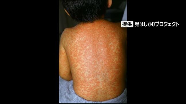 沖縄県内で「はしか」患者を確認　2019年以来6年ぶり　カンボジアから帰国後に症状|TBS NEWS DIG