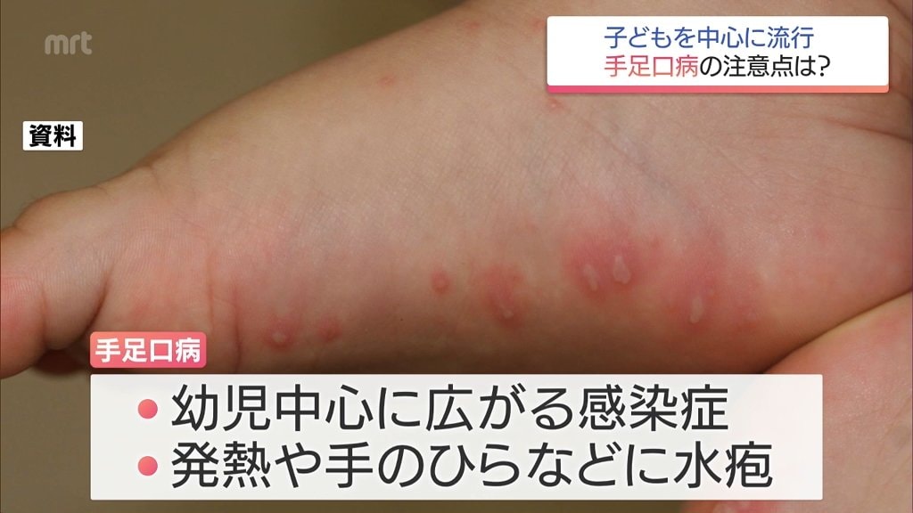 手足口病」 宮崎県内で流行警報レベル超 小児科医に注意点を聞く | MRT