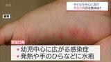 「手足口病」 宮崎県内で流行警報レベル超　小児科医に注意点を聞く|TBS NEWS DIG