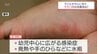「手足口病」 宮崎県内で流行警報レベル超　小児科医に注意点を聞く　|　MRTニュース ｜ ＭＲＴ宮崎放送