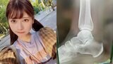 でんぱ組.inc 鹿目凛さん 右足首を捻挫 レントゲン写真も公開|TBS NEWS DIG