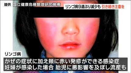赤い発疹ができる「リンゴ病」9週ぶり減少も「依然警戒が必要」宮城