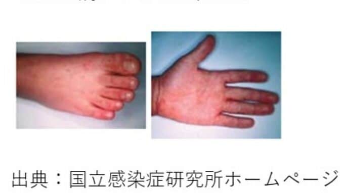 香川県に「手足口病流行警報」手洗いうがいの徹底やタオル共用を避けるなど予防呼びかけ　|　岡山・香川のニュース | 天気 | RSK山陽放送