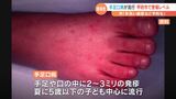 手足や口の中に発疹が出来る「手足口病」甲府市で警告レベル 手洗いの徹底など感染の予防呼びかけ|TBS NEWS DIG