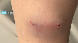 住宅街で女性がアライグマとみられる動物に噛まれる 足が腫れスニーカーにも大きな穴 対処は?【岡山】 |TBS NEWS DIG
