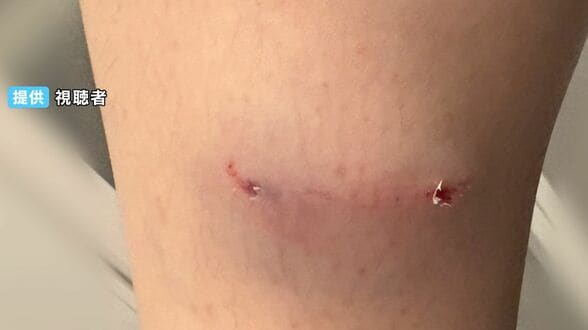 アライグマとみられる動物に住宅街で女性が噛まれる 足が腫れスニーカーにも大きな穴 対処は?【岡山】  | 岡山・香川のニュース | 天気 | RSK山陽放送
