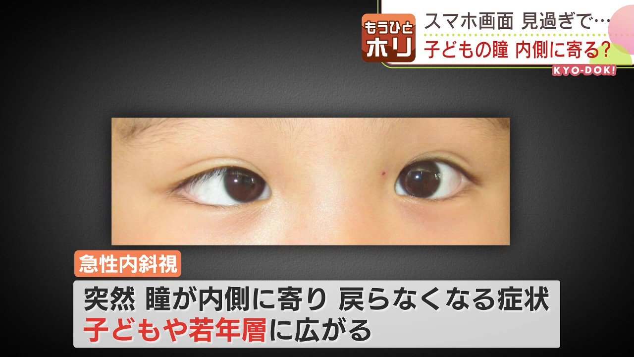 スマホの見過ぎで 突然眼球が内側に寄る 見えない子どもが急増 視力低下 Tbs News Dig スマホの見過ぎで 突然眼球が内側に寄る 見えない子どもが急増 視力低下 Tbs News Dig