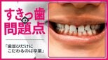 子どもと大人で異なる「すきっ歯」のとらえ方 「歯並びだけにこだわるのは卒業を」と矯正歯科医が指摘する理由|TBS NEWS DIG