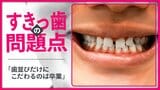 子どもと大人で異なる「すきっ歯」のとらえ方 「歯並びだけにこだわるのは卒業を」と矯正歯科医が指摘する理由|TBS NEWS DIG