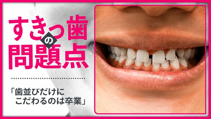 子どもと大人で異なる「すきっ歯」のとらえ方　「歯並びだけにこだわるのは卒業を」と矯正歯科医が指摘する理由|TBS NEWS DIG