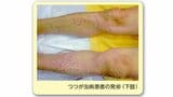 今年度初の「つつが虫病」40代男性が頭痛や発熱などの症状　治療が遅れると命に関わる場合も（山形）|TBS NEWS DIG