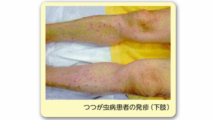 今年度初の「つつが虫病」40代男性が頭痛や発熱などの症状　治療が遅れると命に関わる場合も（山形）|TBS NEWS DIG