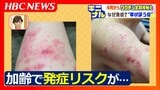 加齢とともに発症リスクが高まる『帯状ほう疹』針に刺されたような痛みや後遺症も…4月からスタートする65歳以上が対象の予防ワクチンの定期接種がキニナル | 北海道のニュース|HBC北海道放送