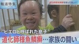 “ピエロと呼ばれた息子”道化師様魚鱗癬【報道特集】|TBS NEWS DIG