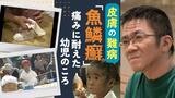 「痛いよー!」風呂に入るだけで苦しんだ6歳のころ 「魚鱗癬」とともに生きる28歳の青年 | 福岡のニュース|RKB NEWS|RKB毎日放送