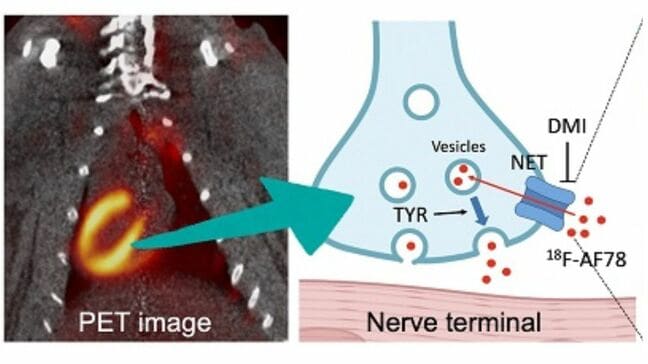 心不全やパーキンソン病の早期診断に向けた新たなPET検査薬を世界初のヒト評価に成功【岡山大学など】|TBS NEWS DIG