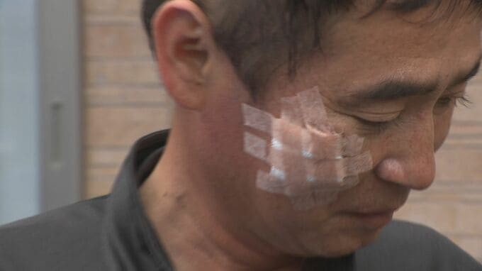 「死ぬ覚悟でやりあった」 クマの目をたたきつける男性 散歩中に襲われ顔やすねにけが　|　石川県のニュース｜MRO北陸放送