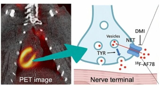 心不全やパーキンソン病の早期診断に向けた新たなPET検査薬を世界初のヒト評価に成功【岡山大学など】|TBS NEWS DIG