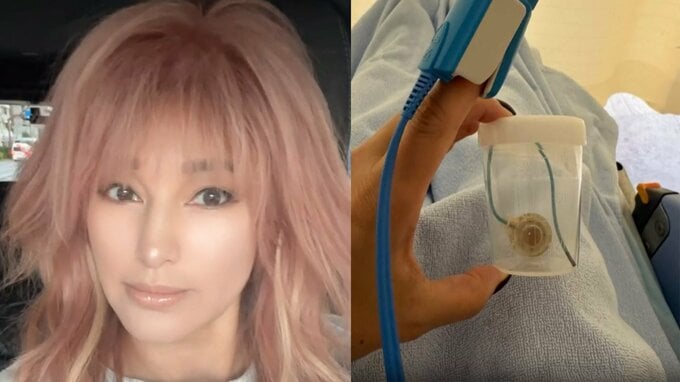 【がん闘病】梅宮アンナさん　「今回の治療での抗がん剤期間が終了したので、抜去する事を選びました」　皮下埋め込み型中心静脈ポート抜去を報告|TBS NEWS DIG