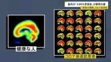 コロナ後遺症「ブレインフォグ」克服の糸口につながる研究結果 患者の脳を分析「アンパ受容体」の密度が健常者より高いと判明 横浜市立大学病院 新たな臨床試験も【news23】|TBS NEWS DIG