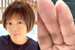 【 がん闘病 】石原詢子 抗がん剤の副作用を吐露「ここのところ、足の浮腫が尋常じゃなく・・」「手足の指の痺れ、、そして手の指の皮がめくれてきて痛い」|TBS NEWS DIG