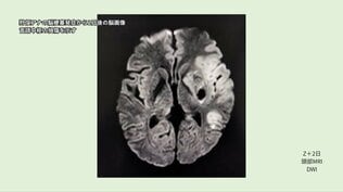 【言葉を失ったアナウンサー】脳梗塞による失語症 リハビリを「楽しんだ」 陰で猛烈な努力… こなした膨大なプリント、学習ドリル【第2話】|TBS NEWS DIG