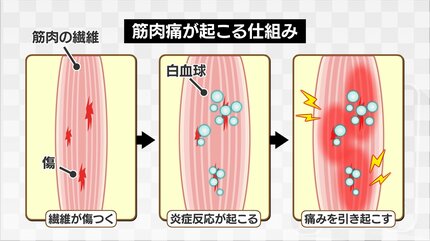 年を取ると “筋肉痛” が遅く出る…は本当？整形外科医に聞いて