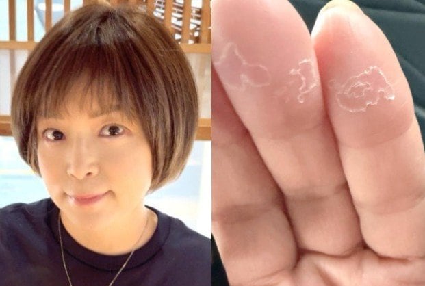 【 がん闘病 】石原詢子　抗がん剤の副作用を吐露「ここのところ、足の浮腫が尋常じゃなく・・」「手足の指の痺れ、、そして手の指の皮がめくれてきて痛い」|TBS NEWS DIG