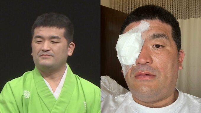 【 すゑひろがりず・三島達矢 】　右目白内障で手術　「手術時間も短く無事に成功」　 SNSに本人明かす　「原因はアトピーの合併症らしく」|TBS NEWS DIG