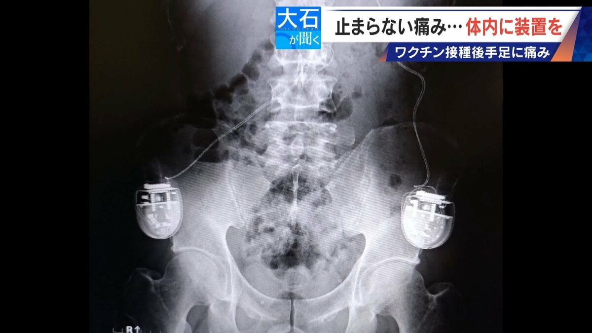 新型コロナワクチン接種後 全身に痛みが “体内に電流流す機械”埋め込み痛み緩和 国は救済申請を｢否認｣