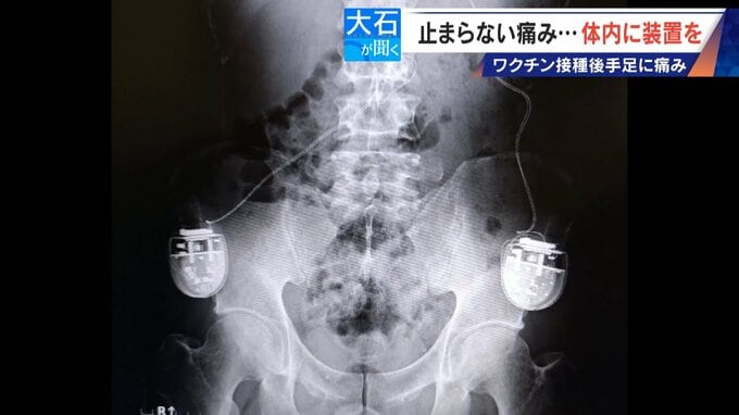 新型コロナワクチン接種後 全身に痛みが “体内に電流流す機械”埋め込み痛み緩和 国は救済申請を｢否認｣　|　名古屋・愛知・岐阜・三重のニュース【CBC news】 | CBC web