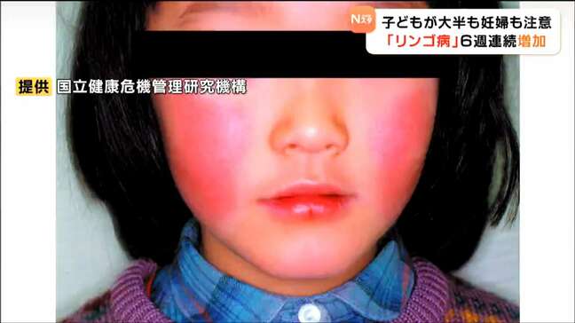 妊婦も要注意!胎児に影響の恐れ 頬が赤くなる「リンゴ病」6週連続増加 宮城|TBS NEWS DIG