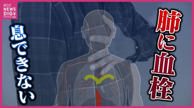 血栓できても「8割の人が無症状」エコノミークラス症候群とは 最短2時間半で死亡例も 災害時にはリスク高まる 防ぐカギは “一日約2リットルの水分摂取”|TBS NEWS DIG