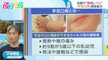 「コロナ」「手足口病」が猛威 「熱中症」と同時発症も “のどの症状”に要注意【ひるおび】|TBS NEWS DIG