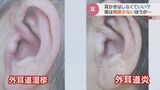 お風呂あがりの耳かきNG?外耳道湿疹や外耳道炎のおそれも…「定期的にする必要は全くない」医師に聞いた“理想の耳掃除”|TBS NEWS DIG