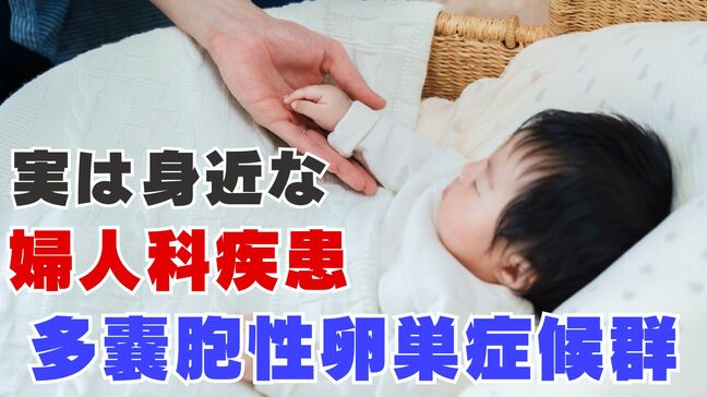 思春期からの月経不順　受診の遅れで不妊につながる可能性も　実は身近な婦人科疾患「多嚢胞性卵巣症候群」とは？|TBS NEWS DIG
