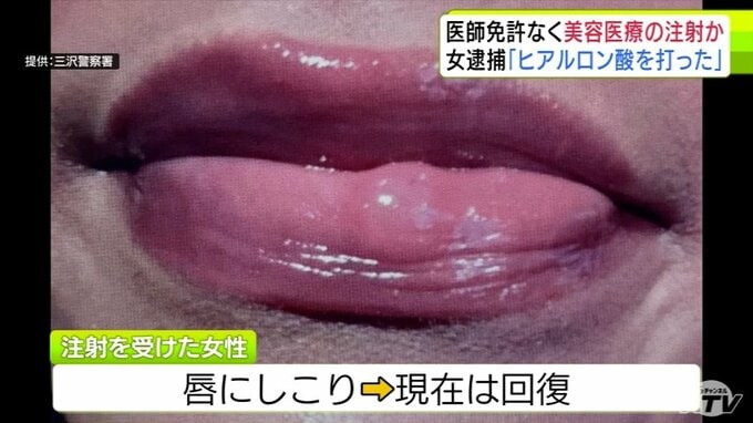 客の唇には" しこり"できる異常…「医師免許のない人に注射されたかもしれない」愛知県のフィリピン国籍エステティシャンの女を逮捕　美容医療目的で注射か「ヒアルロン酸を打った」　青森県警|TBS NEWS DIG